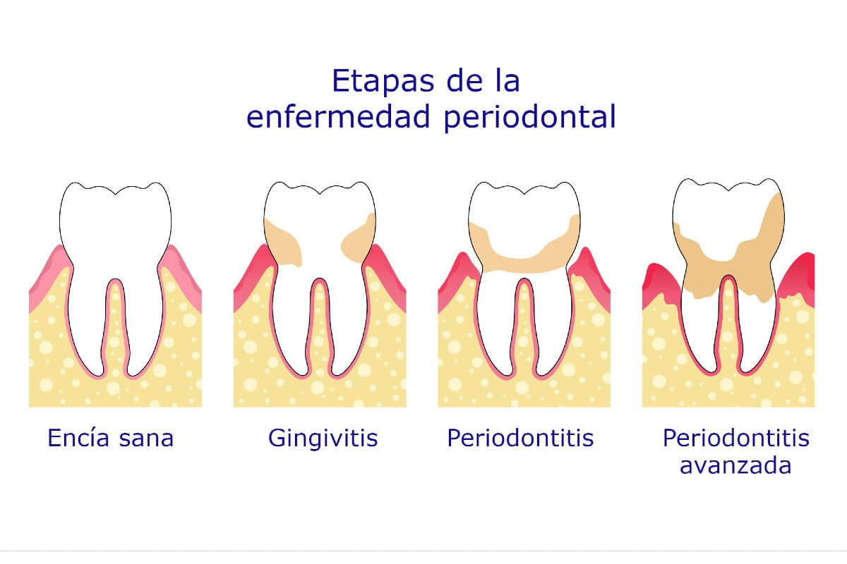 Como Diferenciar Gingivitis De Periodontitis