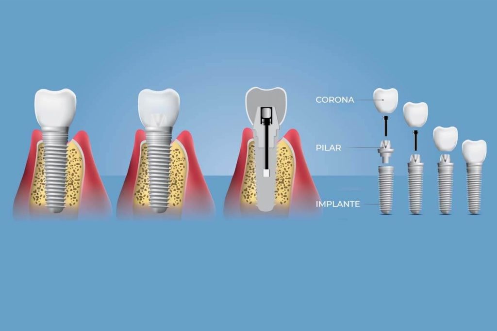Partes De Un Implante Dental